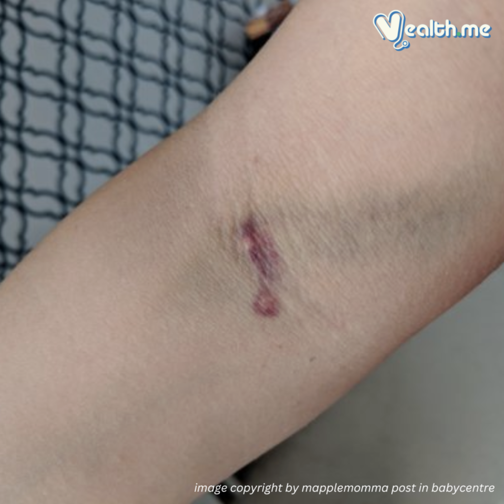 Blood Test Blues When The Needle Leaves A Mark