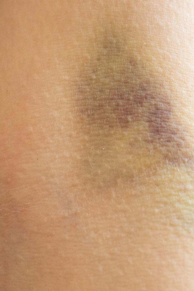 Bruising After A Blood Draw What Does It Mean 