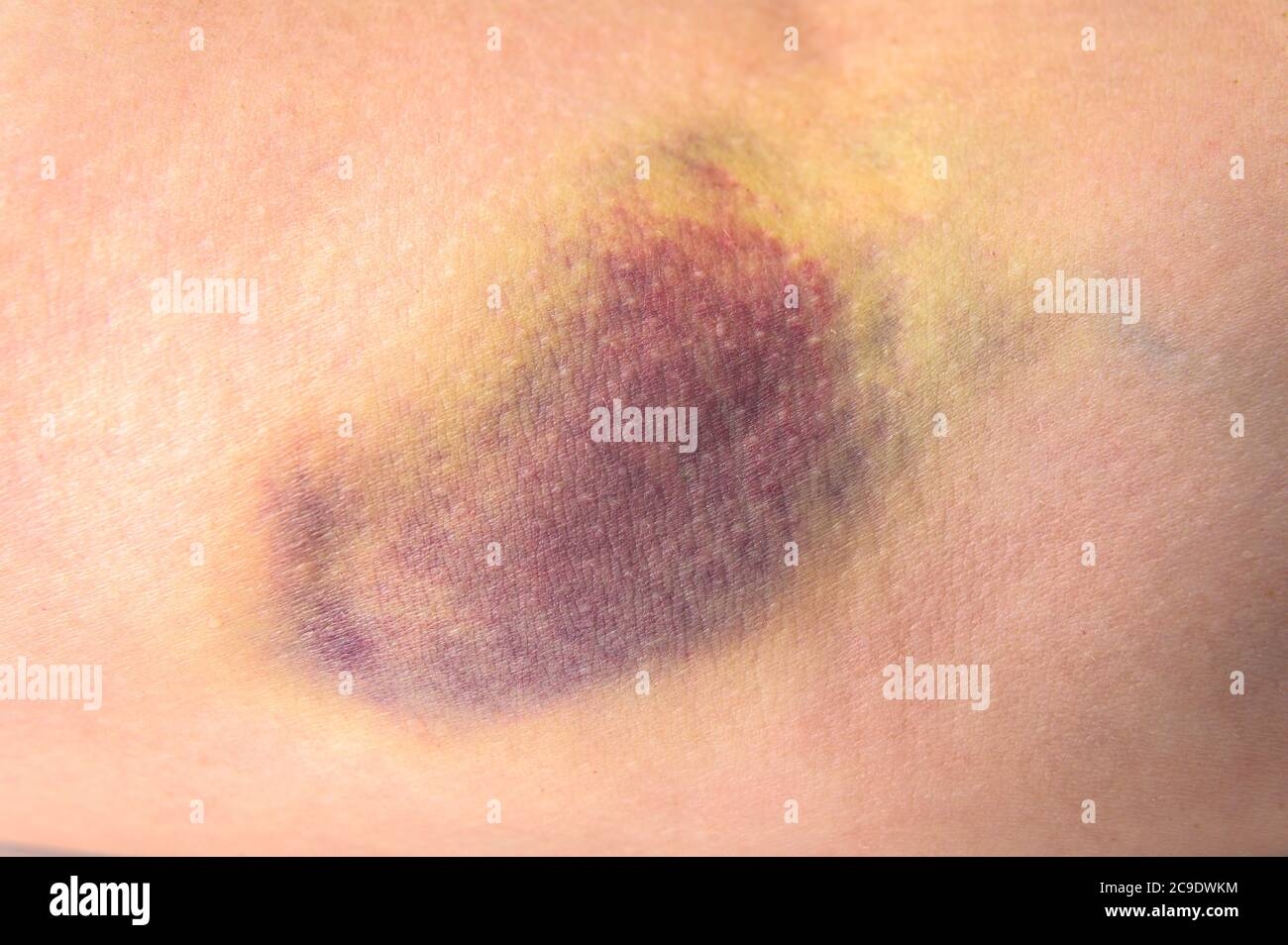 Closeup Of A Very Large Bruise On A Human Arm After A Botched Blood Draw Stock Photo Alamy
