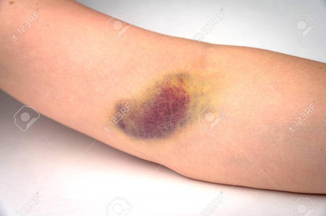 Closeup Of A Very Large Bruise On A Human Arm After A Botched Blood Draw Stock Photo Picture And Royalty Free Image Image 152502828 
